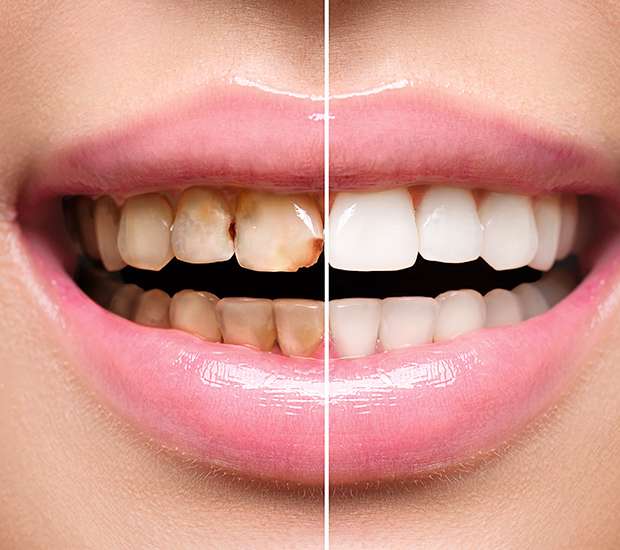 Glendale Dental Implant Restoration