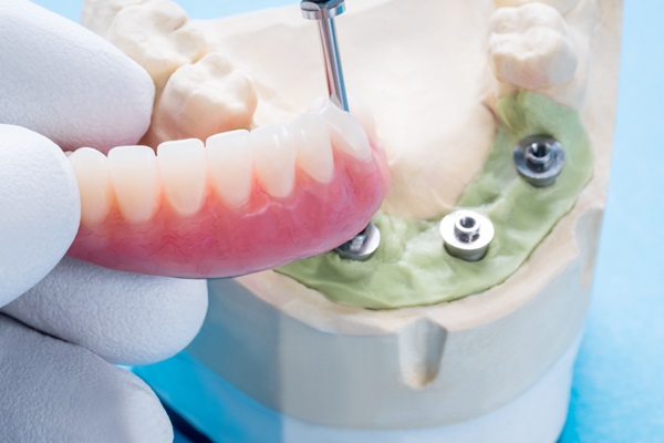 Dentist fitting denture onto dental implant model