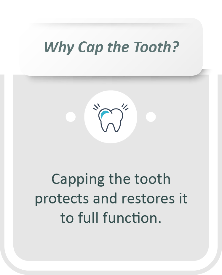 Root canal treatment infographic: Capping the tooth protects and restores it to full function.